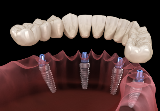 Visualisation 3D d'implants dentaires all-on-4