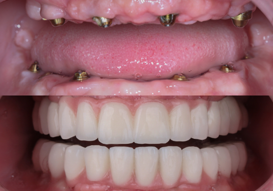 Patient avec des piliers prothétiques en haut et des implants complets en bas